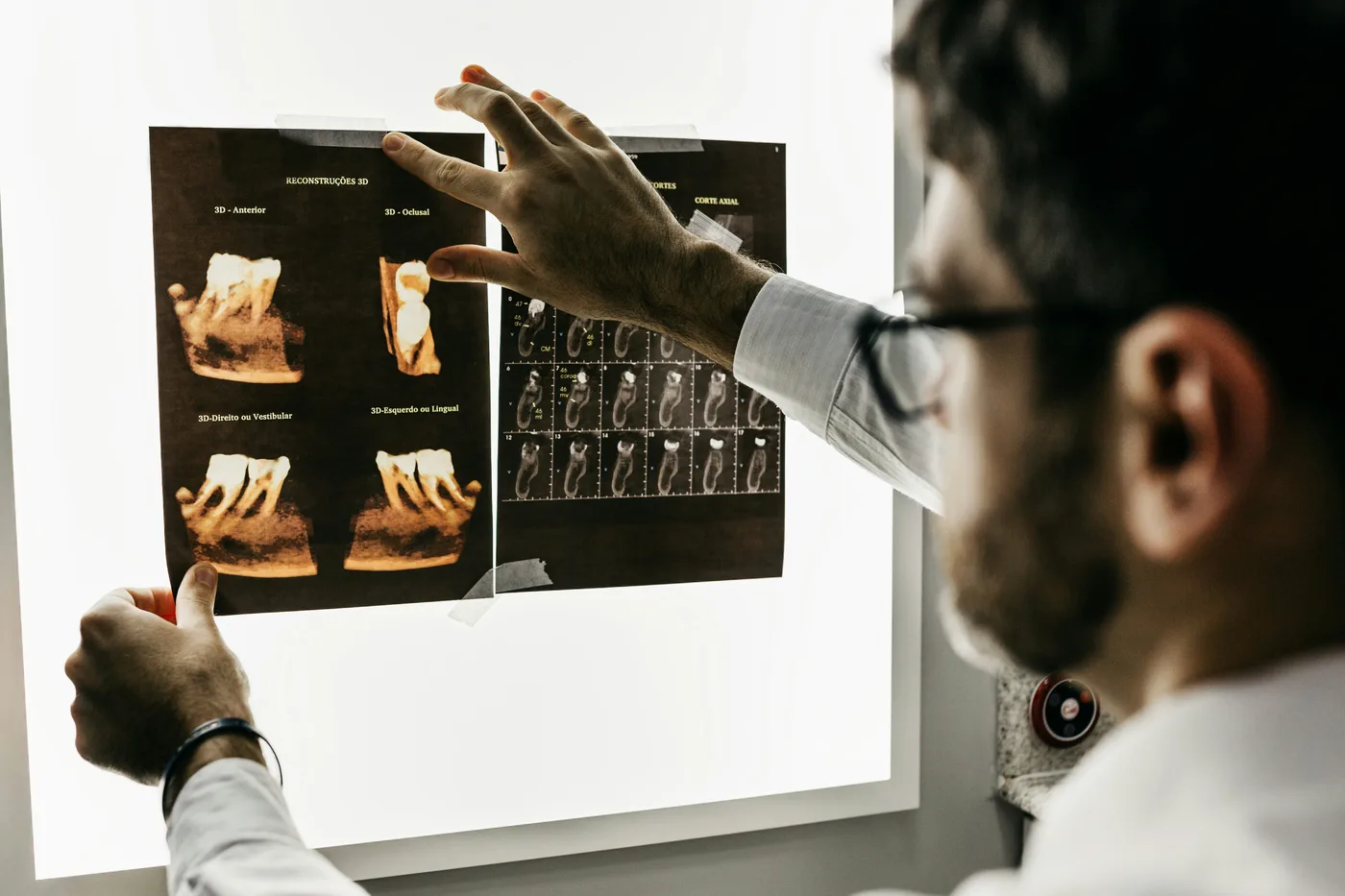 Reconstrucciones 3D impresas y pegadas con cinta a un negatoscopio, señaladas por un clínico.