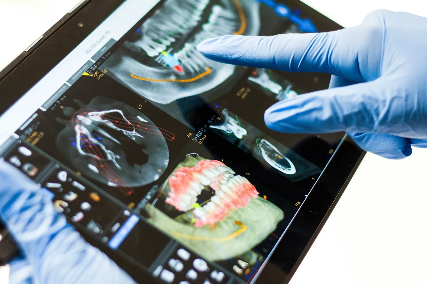 Cortes CBCT, panorámica y arcada 3D reconstruida en una tablet, señalada con un guante.
